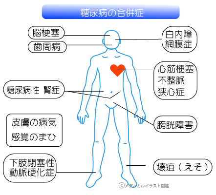 糖尿病合併症