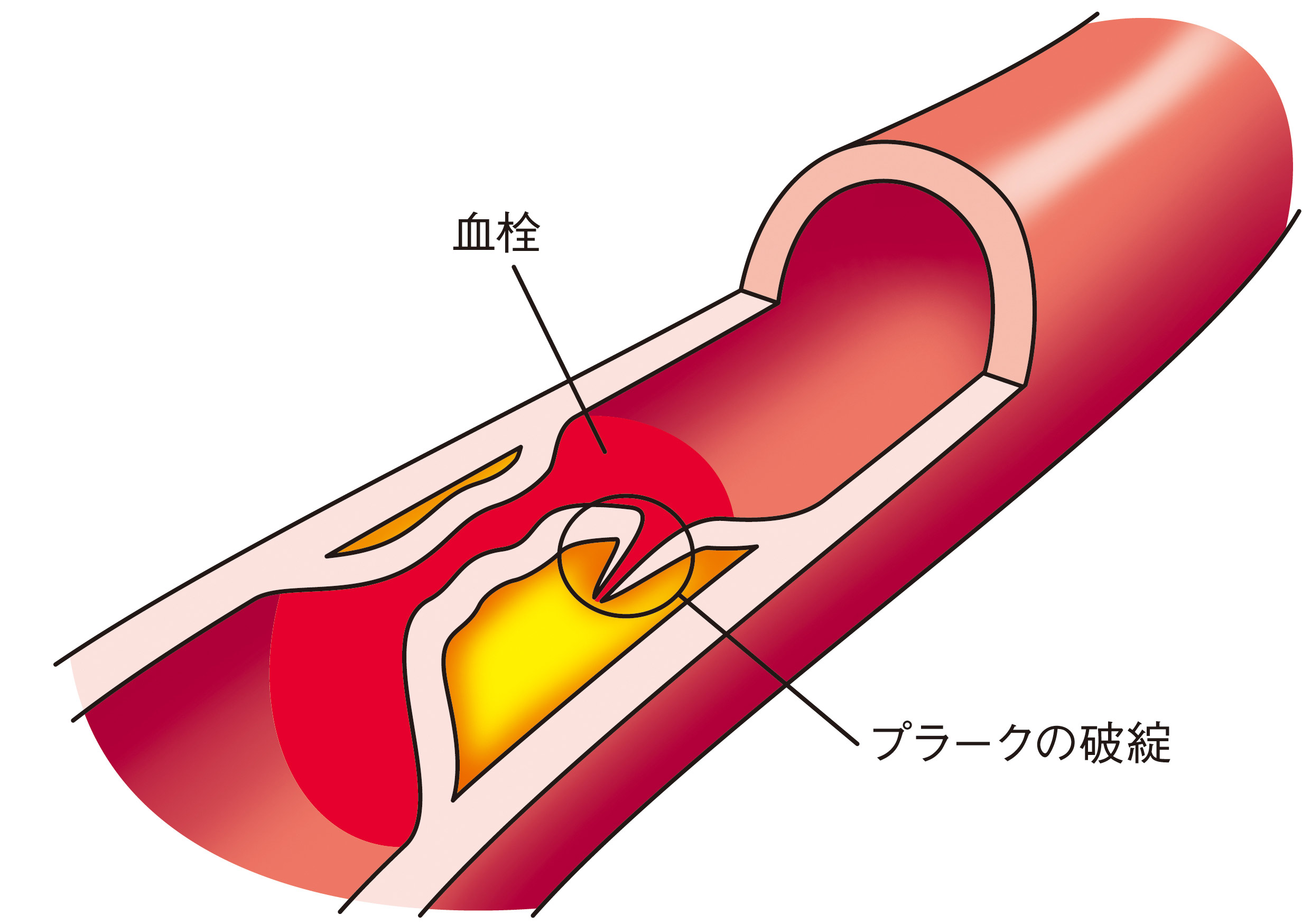 血管閉塞イラスト