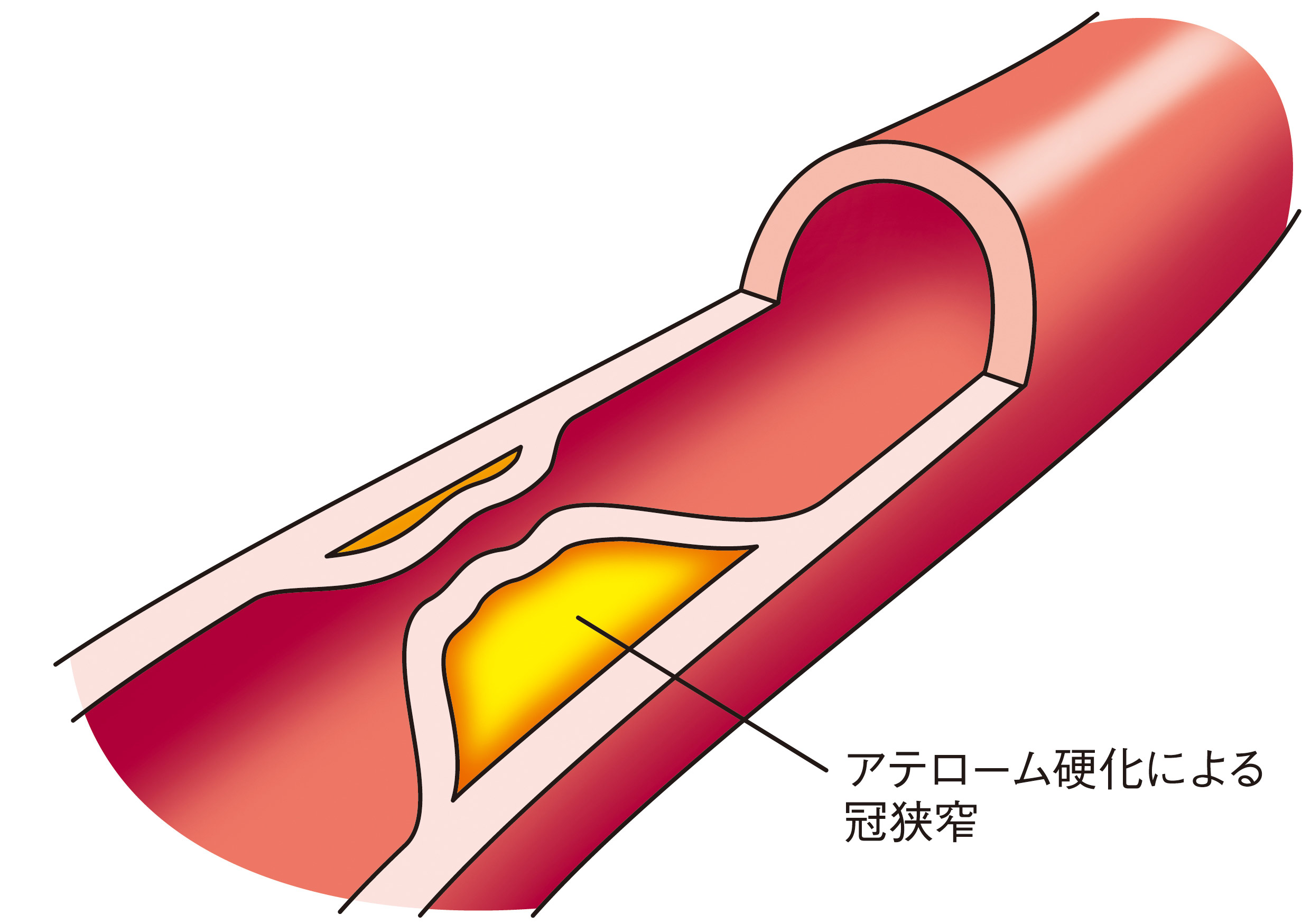 血管イラスト