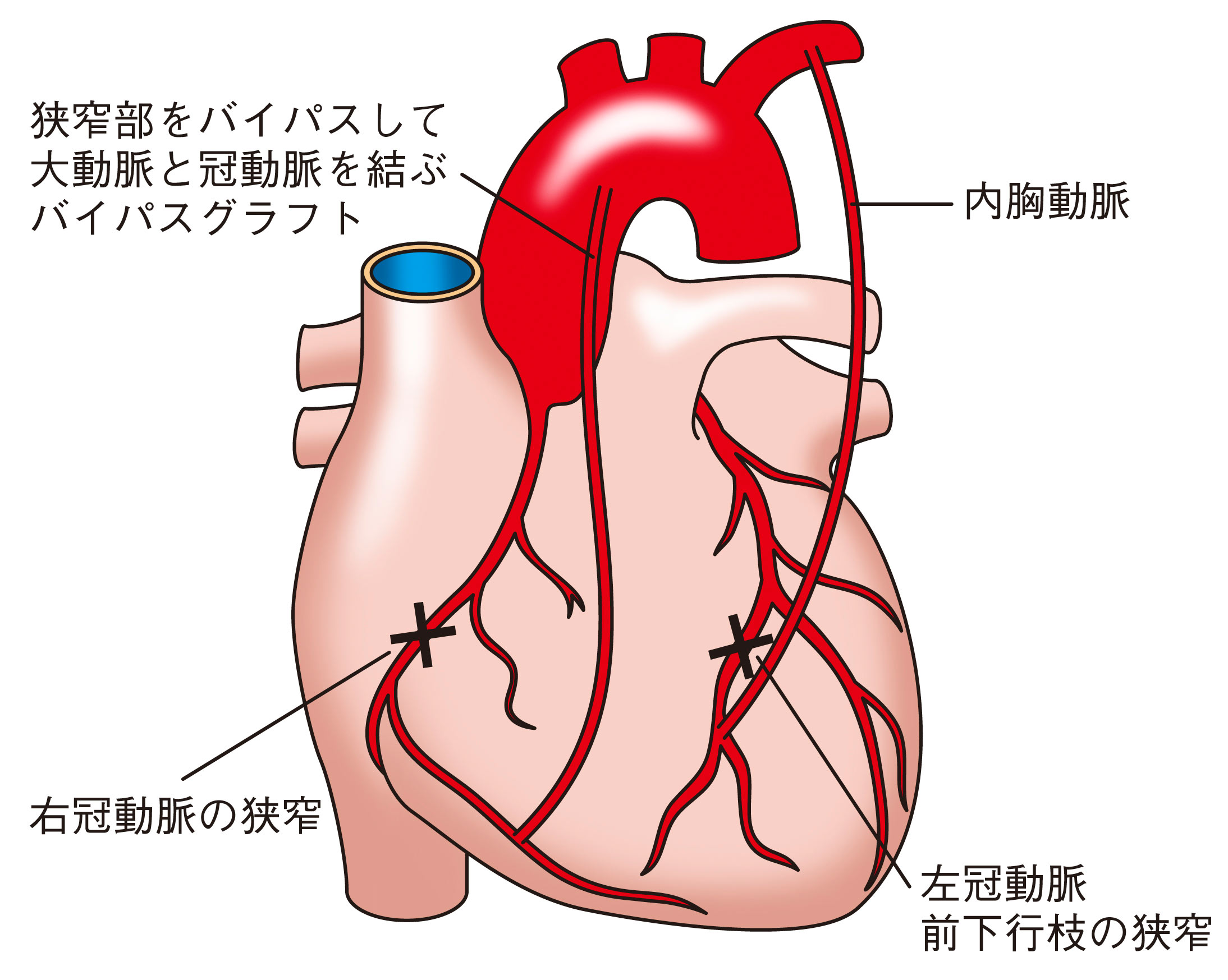 バイパス術イラスト