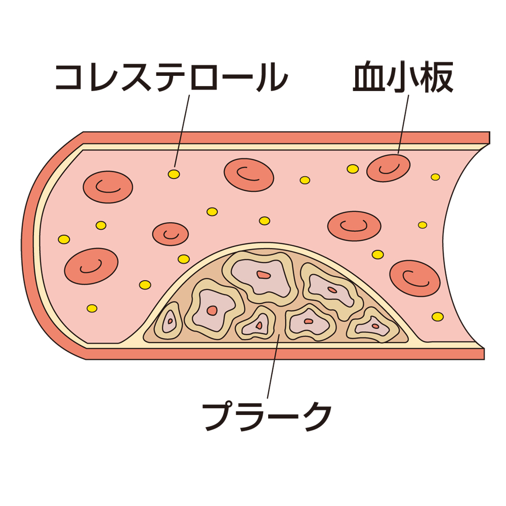 プラークイメージ