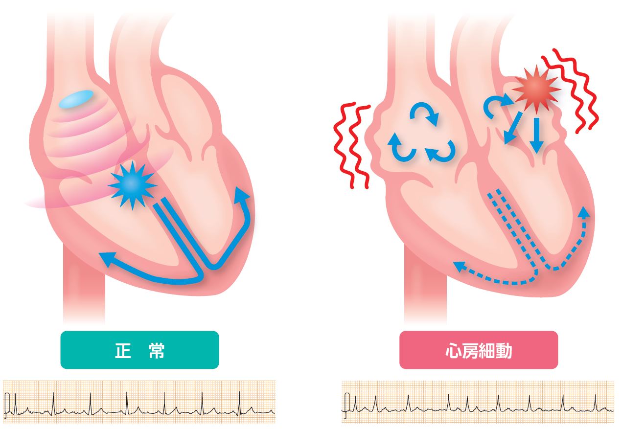 心房細動比較