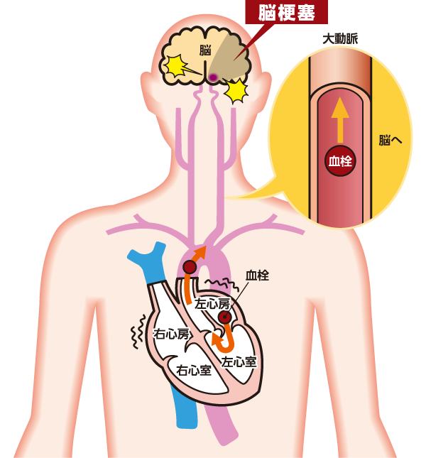 脳梗塞リスク