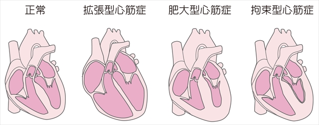 心筋症イラスト