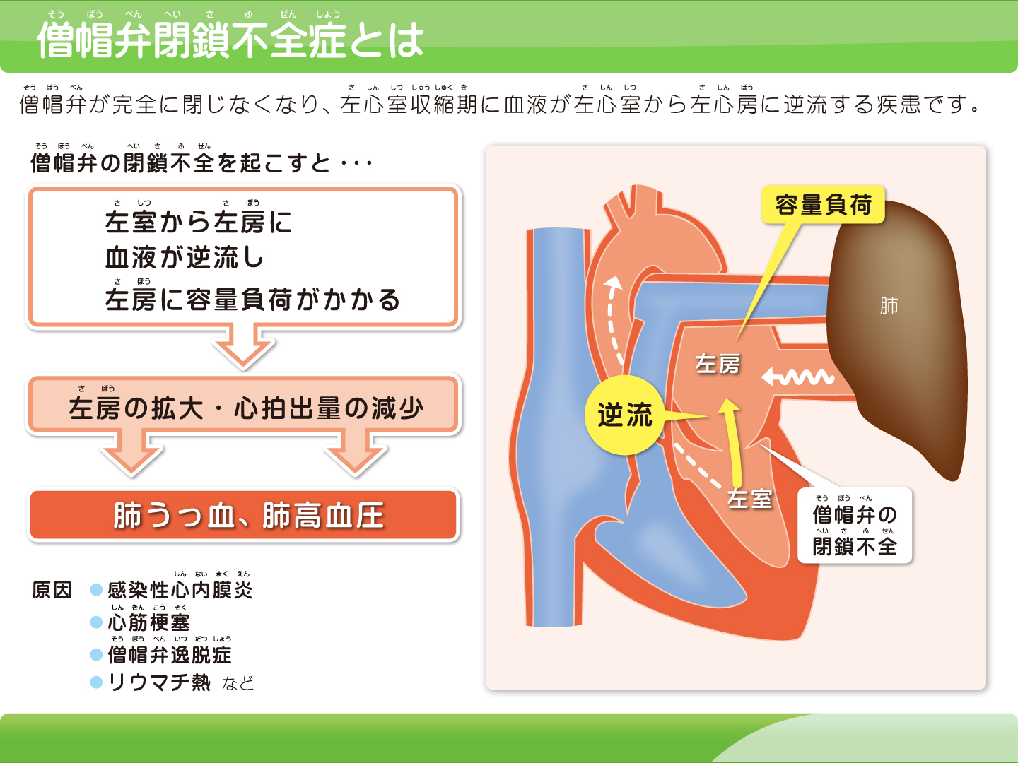 僧帽弁閉鎖不全症とは