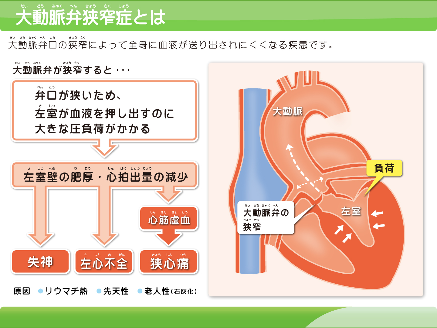 大動脈弁狭窄症とは