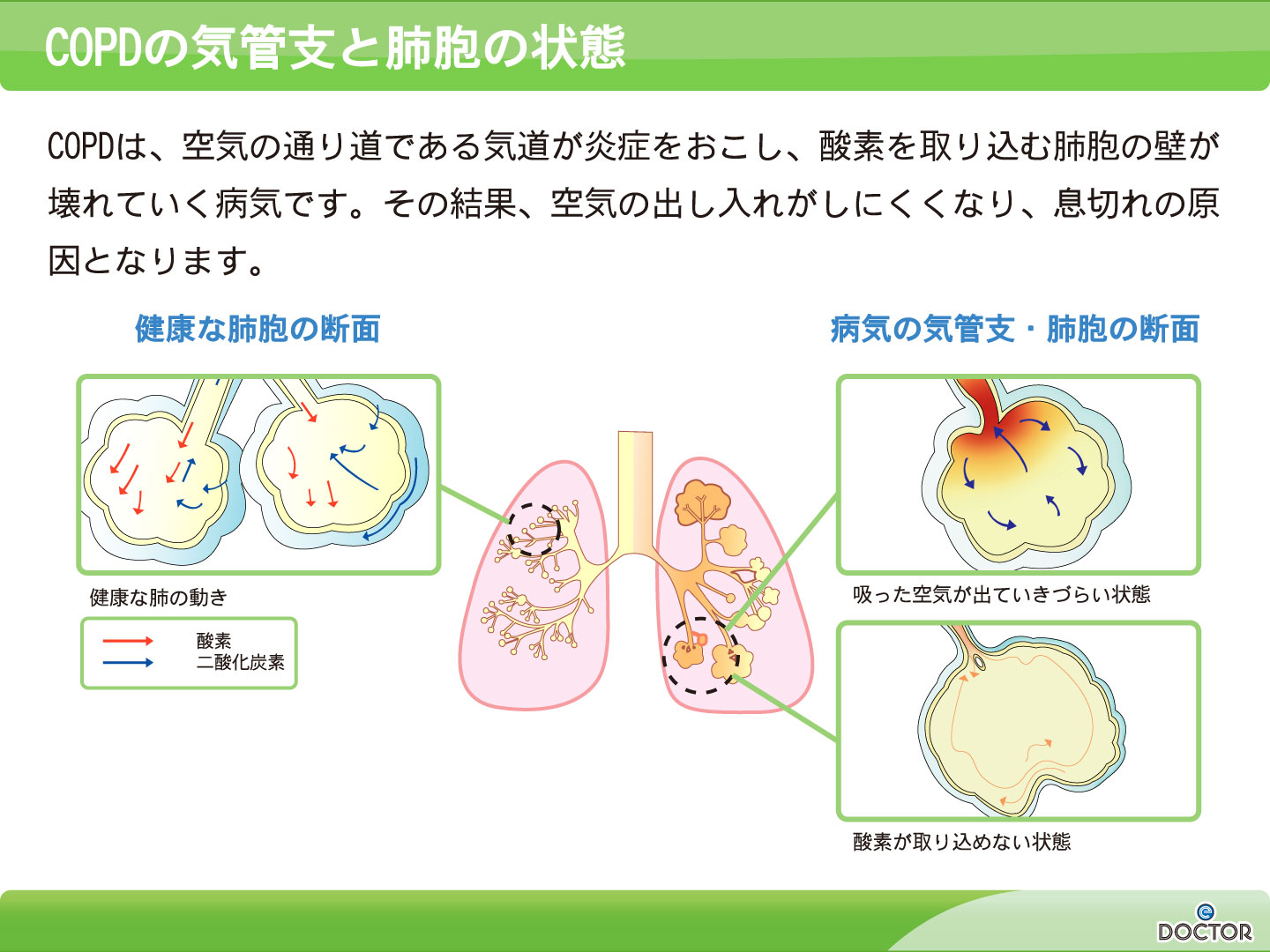 ある ある copd